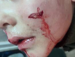 В Коми бездомная собака укусила в лицо шестилетнего ребенка