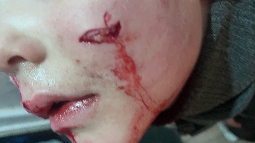 В Коми бездомная собака укусила в лицо шестилетнего ребенка