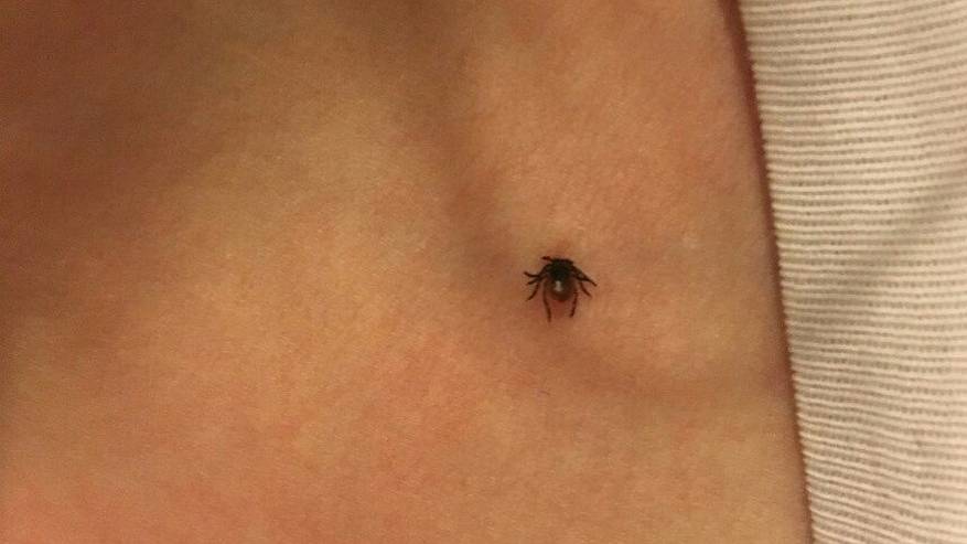 Главная картинка новости: В Коми зарегистрировали первый укус клеща: оказана медицинская помощь